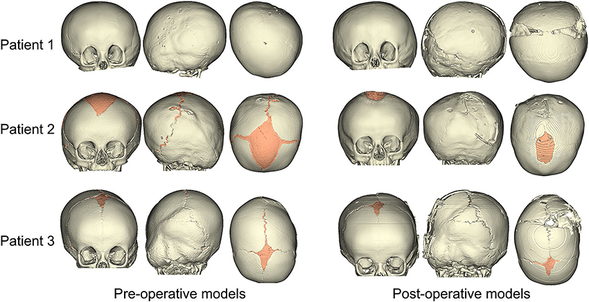 Computational Modeling Of Patient-Specific Craniosynostosis Correction ...